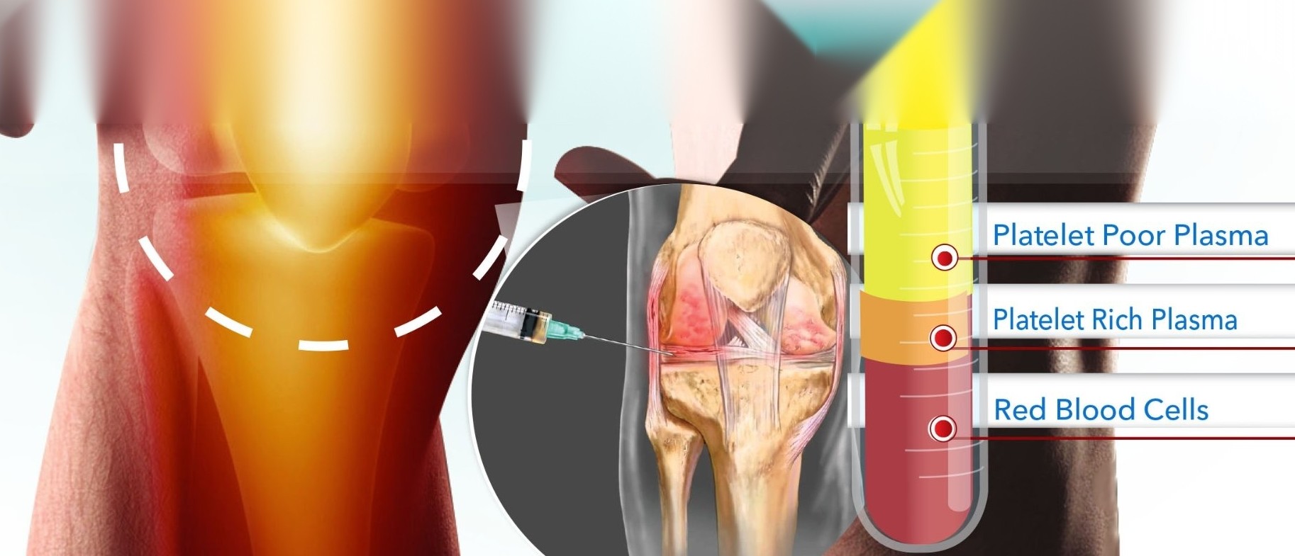 Platelet Rich Plasma Therapy