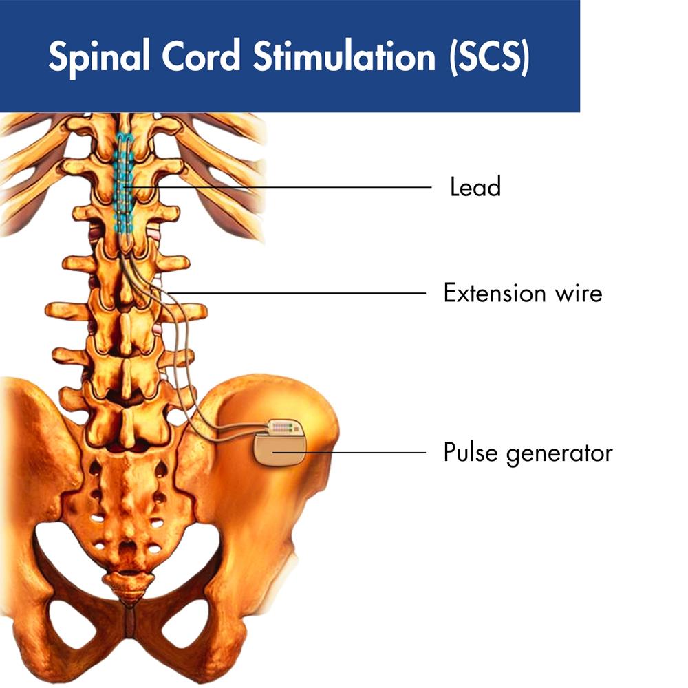 Spinal Cord Stimulator explained Spinal Cord Stimulator explained